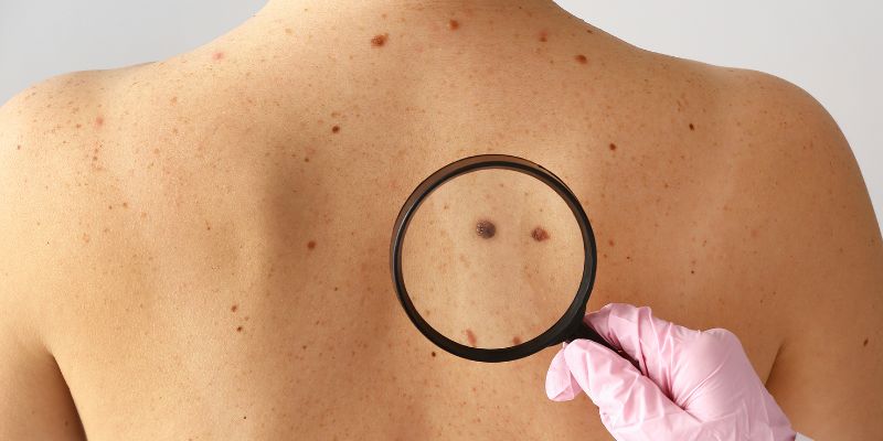 Bí Ẩn Nốt Ruồi Phong Thủy Và Vận Mệnh Chưa Có Lời Giải! 3 Cuộc sống hiện đại có gì mới với nốt ruồi?